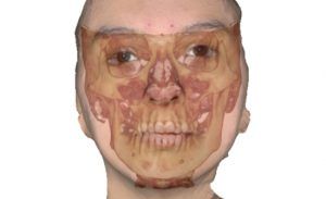 asimetria-facial-cirugia-ortognatica